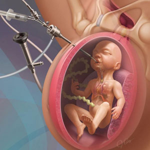 diagnostic fetal procedures fetal therapy